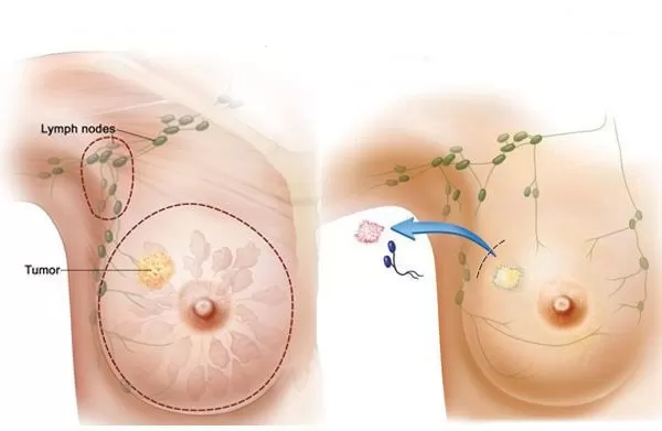Phẫu thuật tạo hình trong ung thư vú - Hành trình hồi sinh vẻ đẹp và tự tin