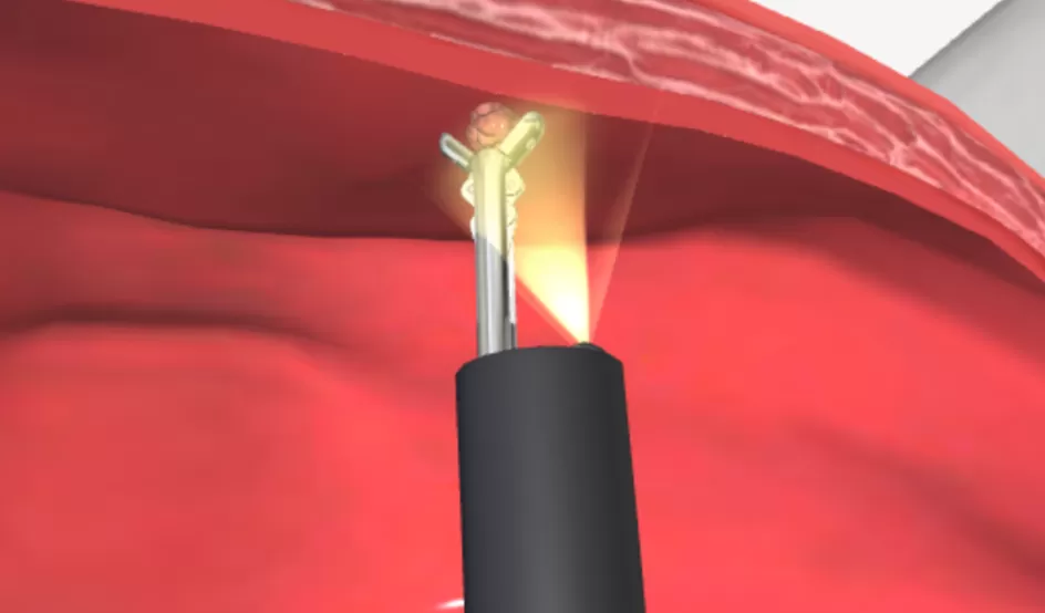 Nội soi bàng quang