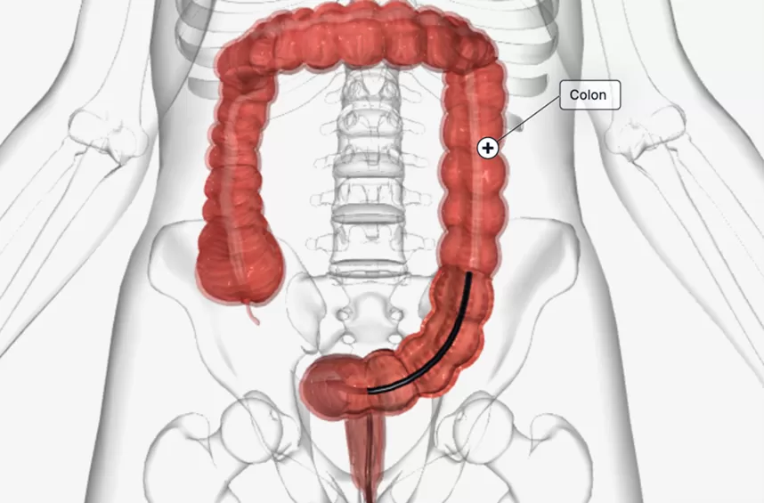 Nội soi đại tràng