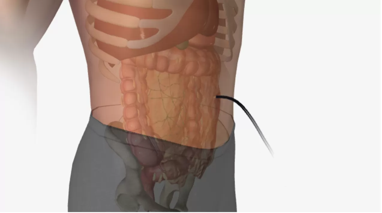 Nội soi ổ bụng