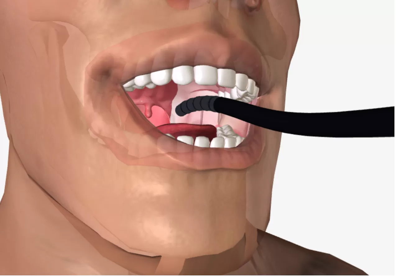 Nội soi thanh quản