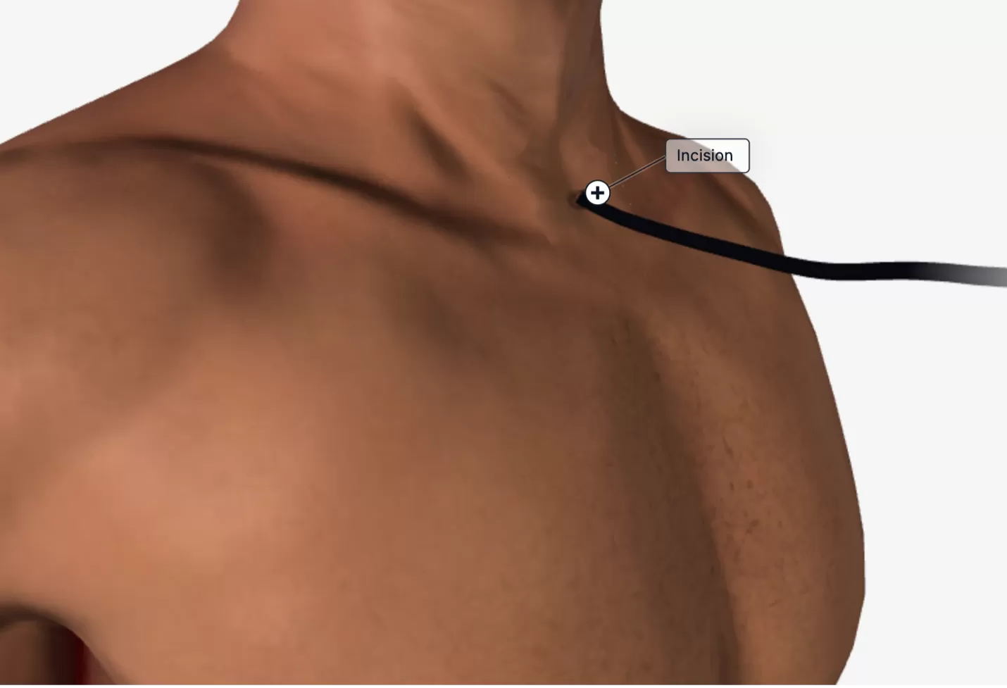 Nội soi trung thất