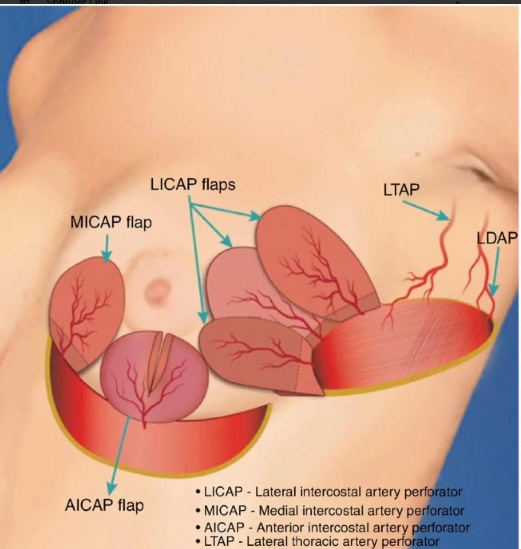 Giữ trọn vẻ đẹp tự nhiên: Tái tạo vú bằng vạt tự thân trong điều trị ung thư vú tại Bệnh viện Ung Bướu Hà Nội