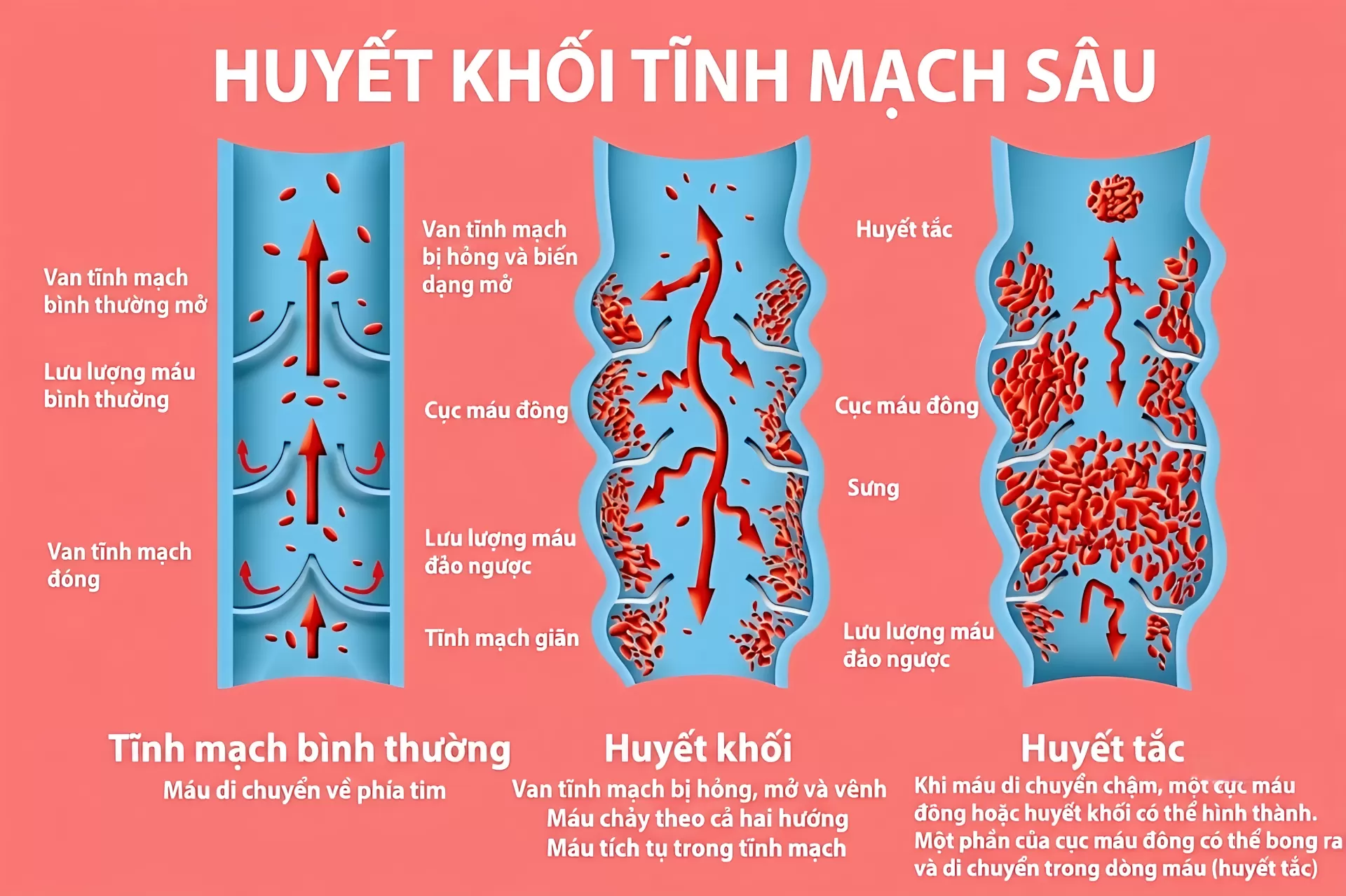 Xét nghiệm D-DIMER trong chẩn đoán huyết khối