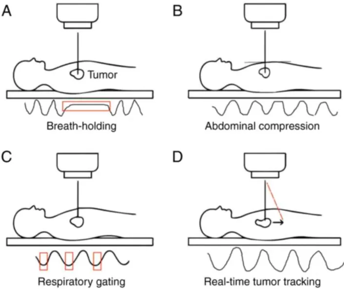 CT4D  trong kiểm soát nhịp thở – Bước tiến mới trong xạ trị khối u phổi và gan