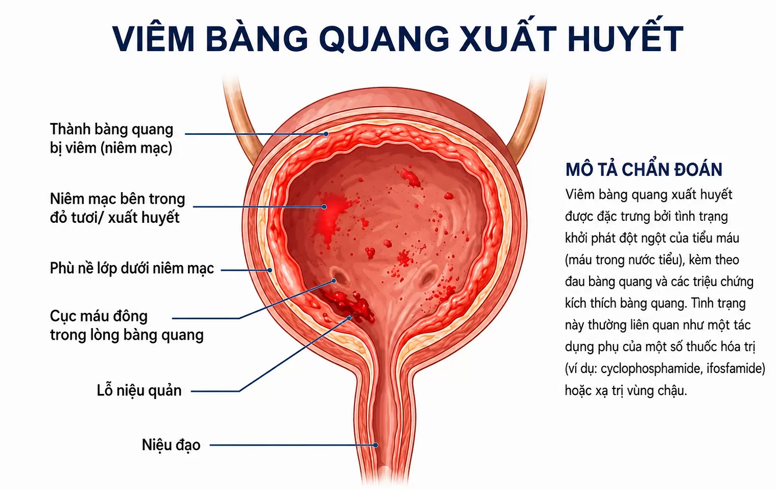 Viêm bàng quang xuất huyết