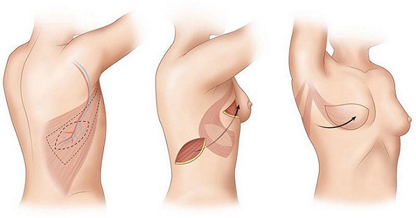 THỜI GIAN PHỤC HỒI SAU MỔ UNG THƯ VÚ TÙY TỪNG PHƯƠNG PHÁP ĐIỀU TRỊ