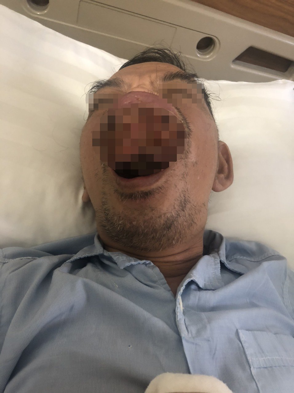 TRÌ HOÃN ĐIỀU TRỊ, NGƯỜI ĐÀN ÔNG BỊ KHỐI UNG THƯ VÙNG KHOANG MIỆNG GÂY BIẾN DẠNG GƯƠNG MẶT