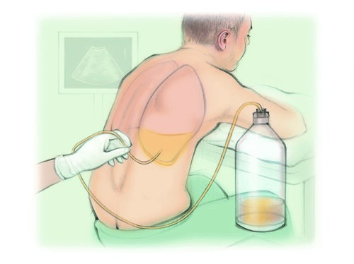 CHỌC THÁO DỊCH MÀNG PHỔI