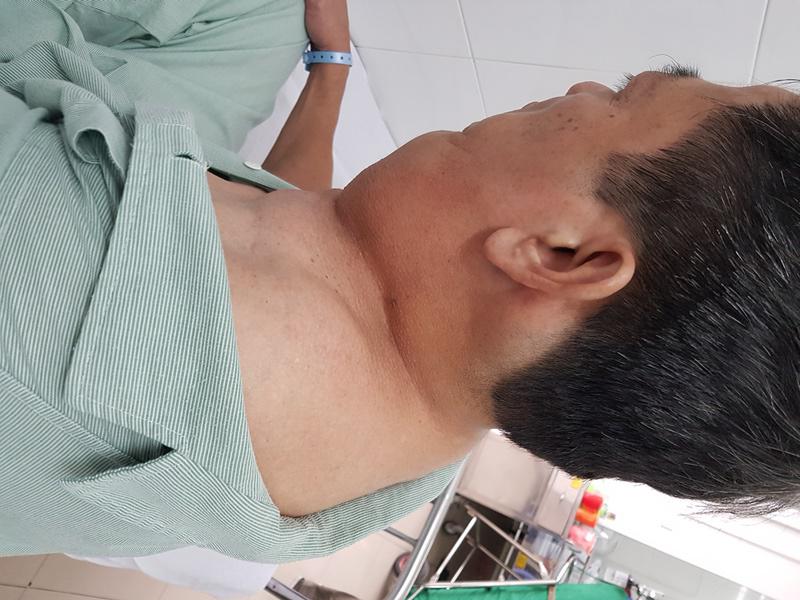 UỐNG 1 LÍT RƯỢU/NGÀY, NGƯỜI ĐÀN ÔNG CÓ CHIẾC CỔ KỲ DỊ, U CHÈN ÉP GÂY KHÓ THỞ