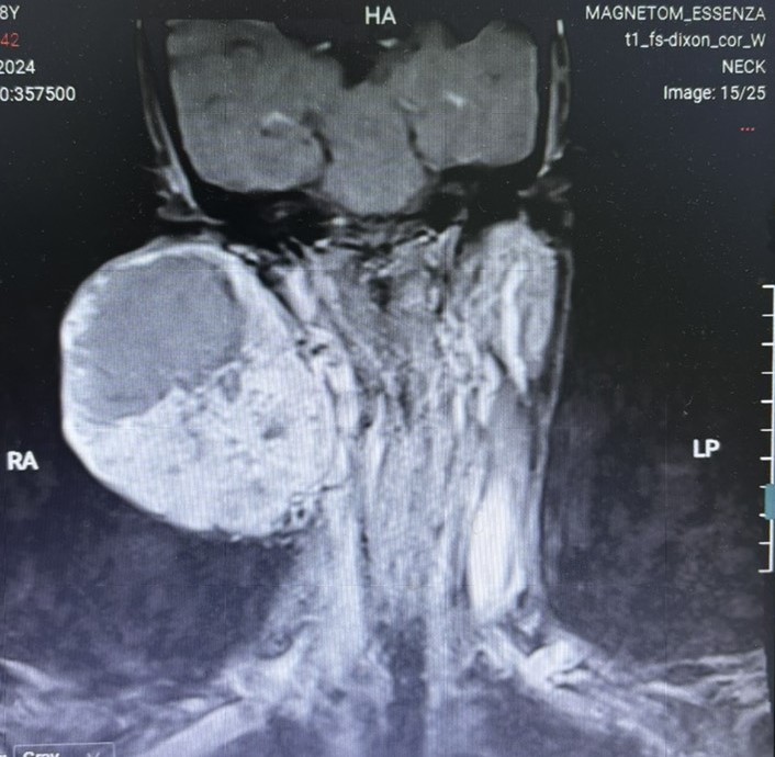 Trì hoãn 14 năm không điều trị, Người phụ nữ suýt mất mạng vì khối U 