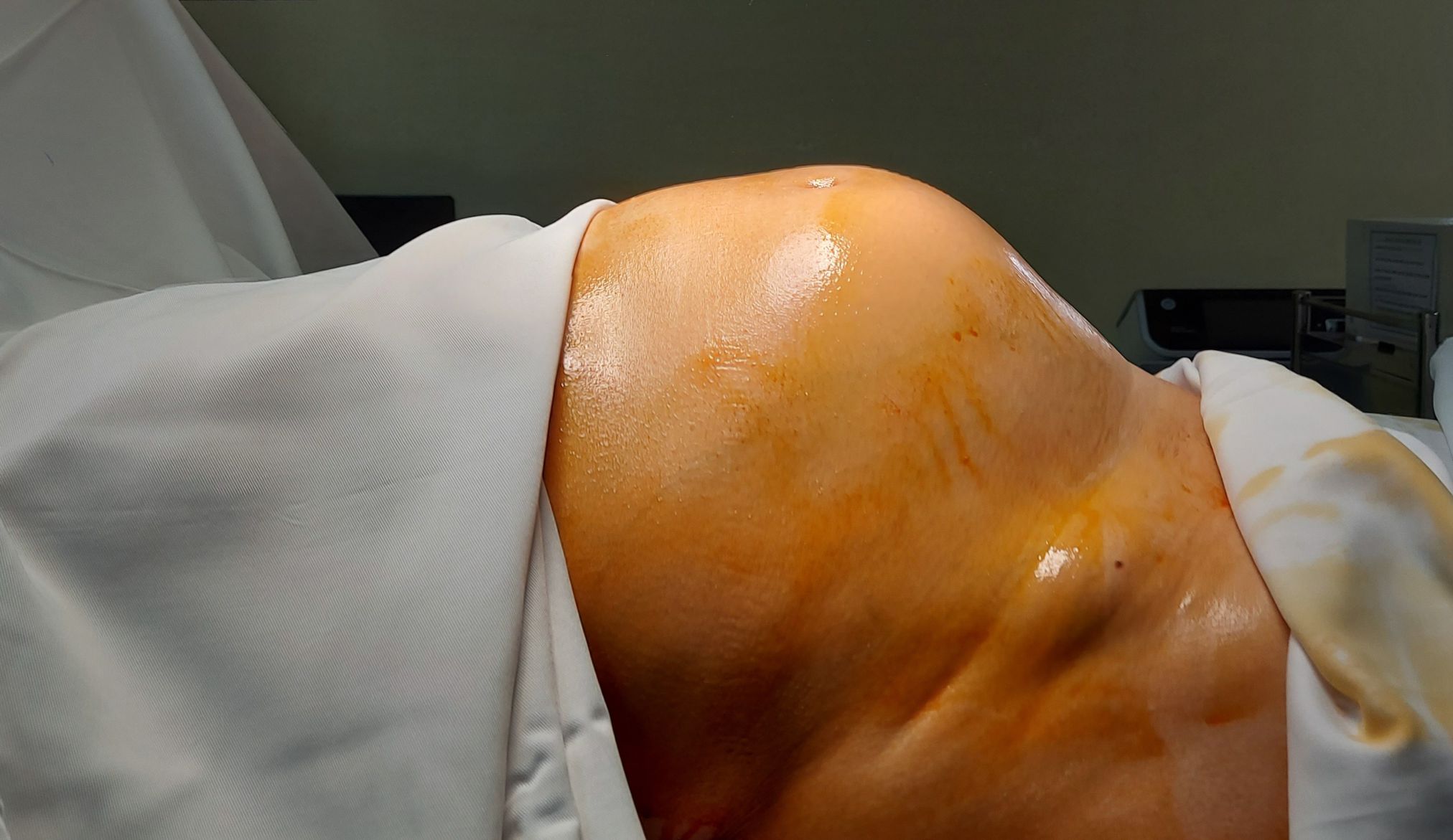 NGƯỜI PHỤ NỮ MANG KHỐI U “KHỦNG” KHIẾN BỤNG TO NHƯ MANG THAI 7 THÁNG DO CHỦ QUAN VỚI “KẺ GIẾT NGƯỜI THẦM LẶNG”