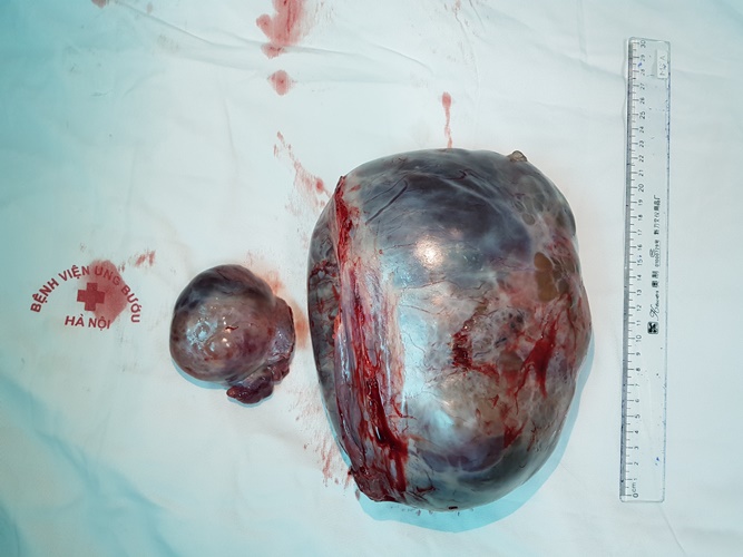 Chần chừ điều trị, người phụ nữ mang khối u buồng trứng to gấp 10 lần bình thường trong ổ bụng