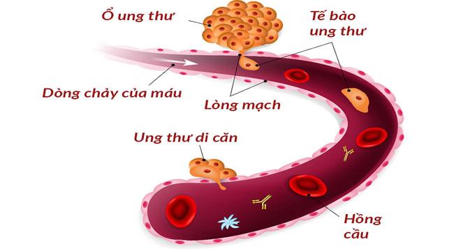 TÌM HIỂU VỀ UNG THƯ DI CĂN