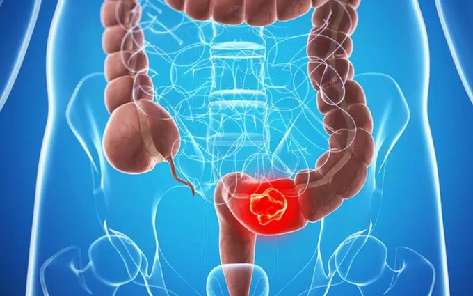 Gói khám sức khỏe định kỳ và phát hiện sớm ung thư đại trực tràng