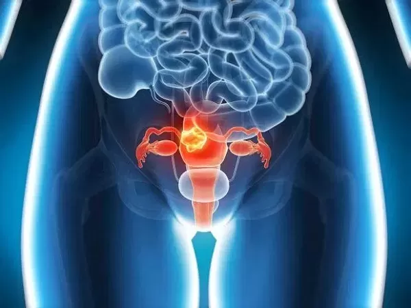 Gói khám sức khỏe định kỳ và phát hiện sớm ung thư buồng trứng