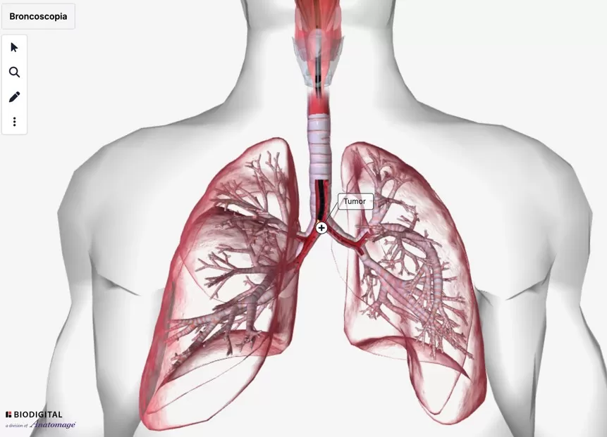 Nội soi phế quản