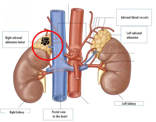 Khối u tuyến thượng thận: Khi nào cần mổ, khi nào chỉ theo dõi?