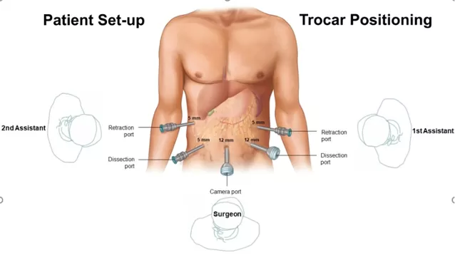 Phẫu thuật nội soi điều trị ung thư dạ dày - Bước tiến nâng cao chất lượng điều trị và phục hồi cho người bệnh