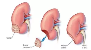 Phẫu thuật cắt thận bán phần: Giải pháp bảo tồn chức năng thận trong điều trị u thận