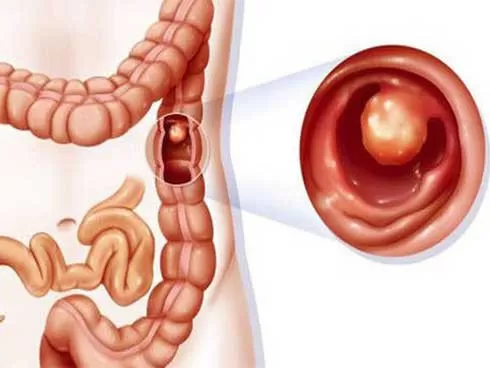 Phẫu thuật nội soi một thì điều trị ung thư đại trực tràng di căn gan: Bước chuyển mình của y học hiện đại