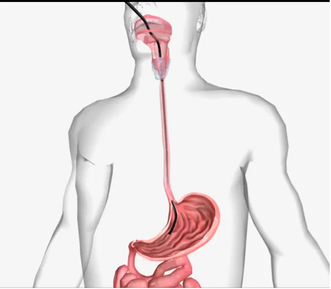 Nội soi đường tiêu hoá trên