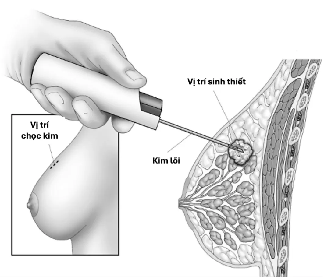 Thông tin về xét nghiệm sinh thiết kim lõi ở vú