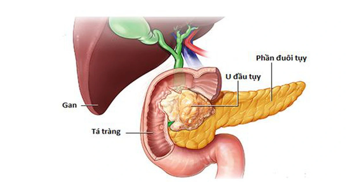 Pancreatic duodenectomy: Solution for tumors in the head of the pancreas and duodenum
