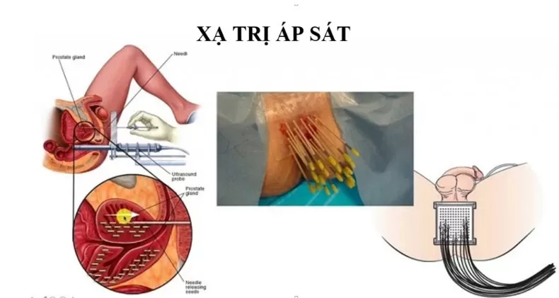 Điều trị xạ trị trong (xạ trị áp sát)