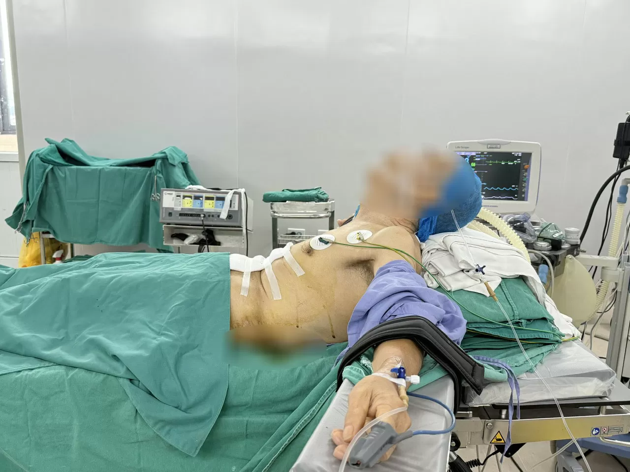 Phẫu thuật ung thư dạ dày cho bệnh nhân gù vẹo cột sống nặng: Thách thức trong gây mê – hồi sức