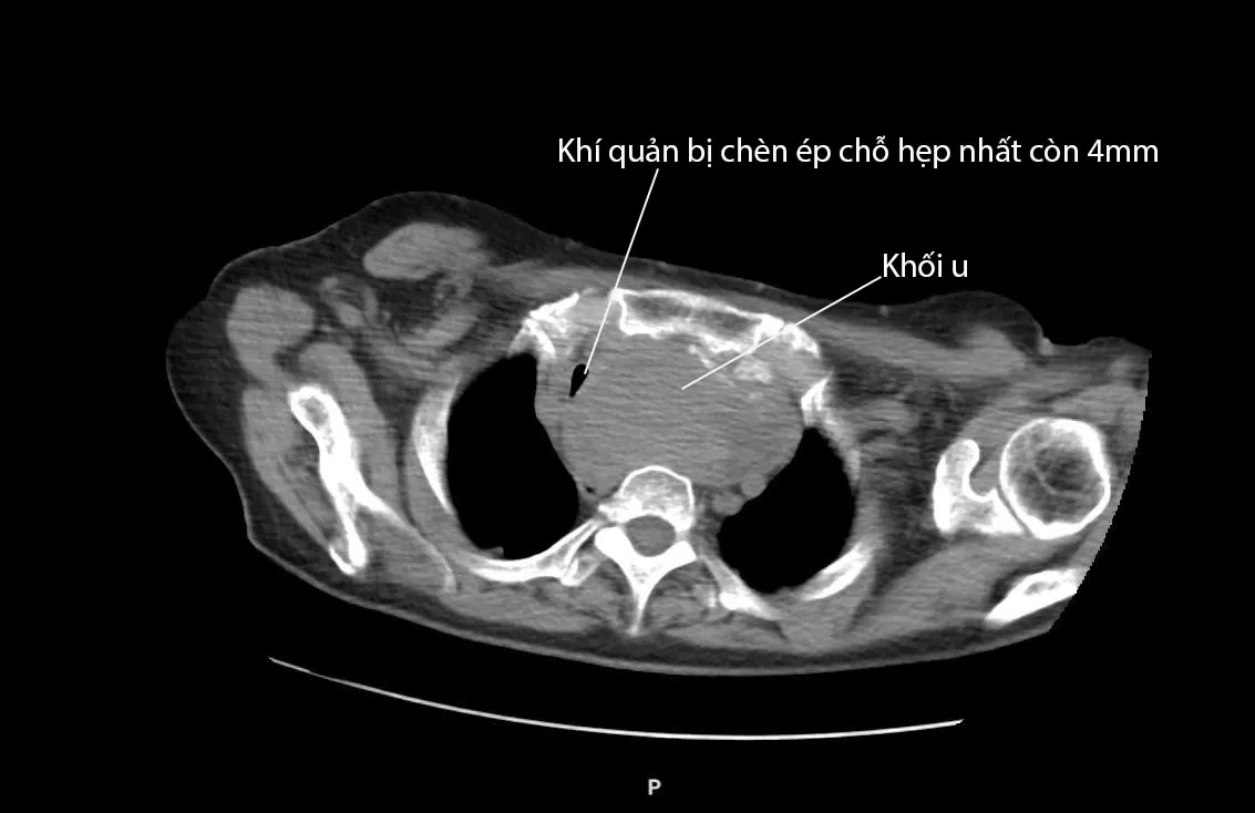 Khối u tuyến giáp lan trung thất chèn ép khí quản: Ca phẫu thuật phức tạp được xử trí an toàn tại Bệnh viện Ung Bướu Hà Nội