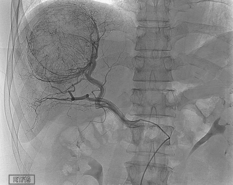 Chụp X-quang thường quy và các xét nghiệm X-quang khác trong chẩn đoán ung thư