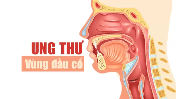 Ung thư đầu cổ: Khi thói quen hằng ngày trở thành thảm họa