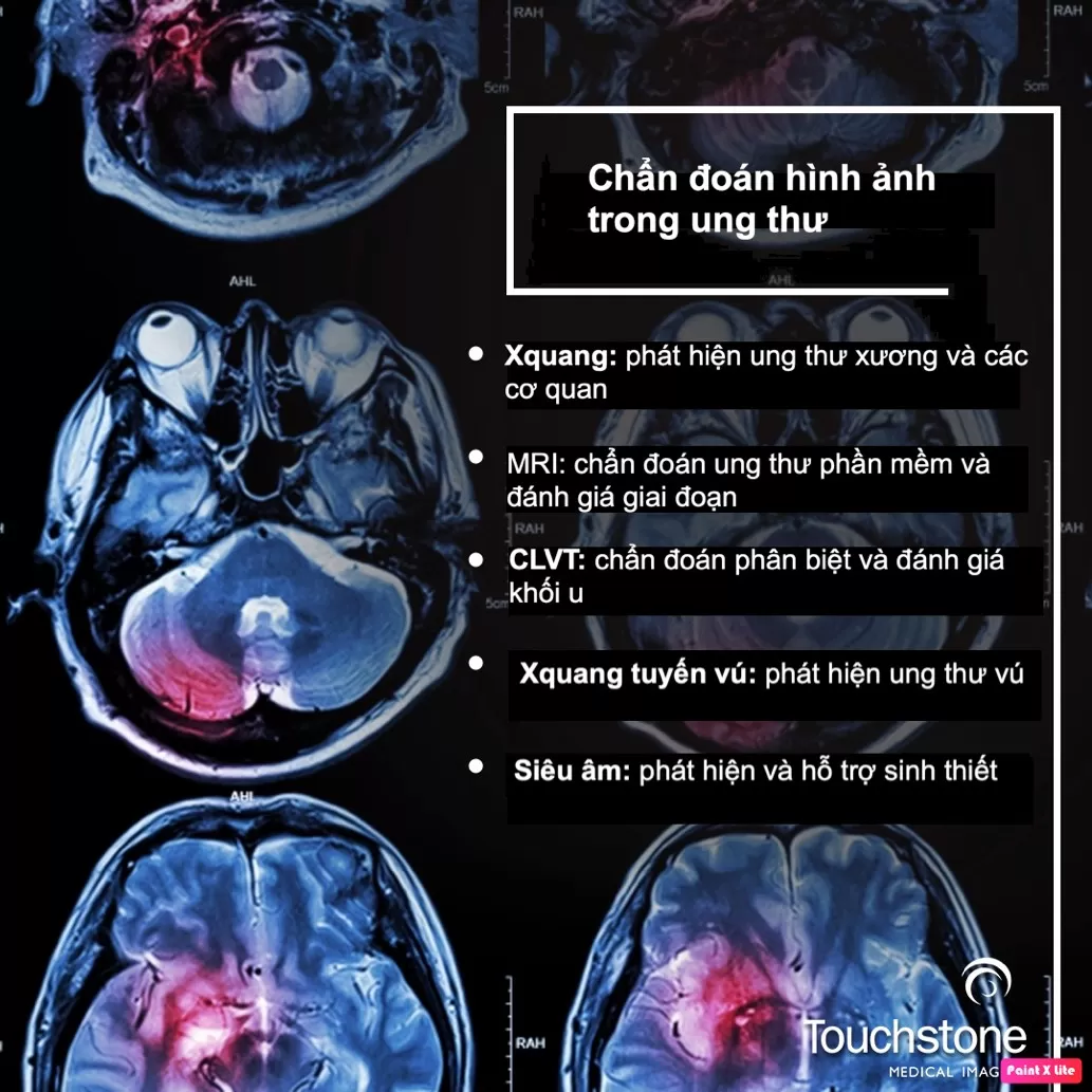 Xét nghiệm chẩn đoán hình ảnh trong ung thư