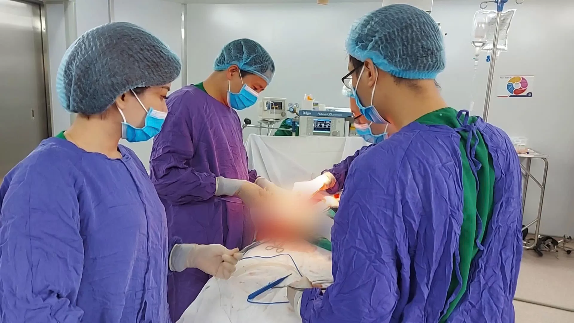 Tạo hình thực quản bằng đại tràng: Kỹ thuật phẫu thuật phức tạp - Giải pháp điều trị hiệu quả cho bệnh nhân ung thư đường tiêu hóa