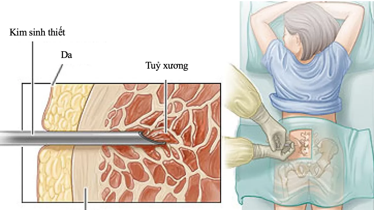 Thông tin về chọc hút và sinh thiết tuỷ xương