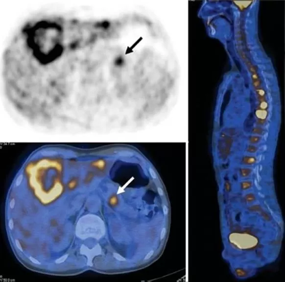 Ung thư không rõ nguyên phát