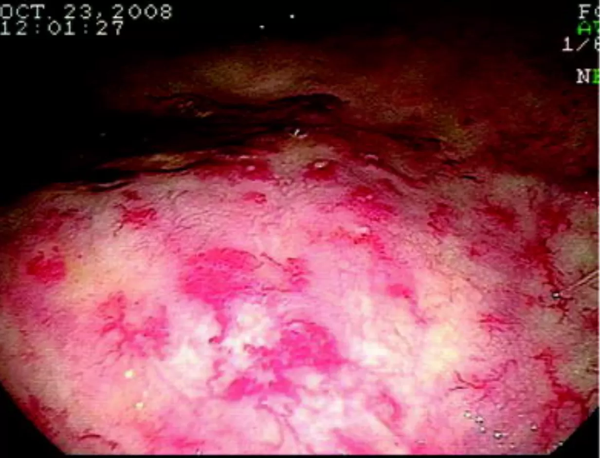 Viêm trực tràng do xạ trị