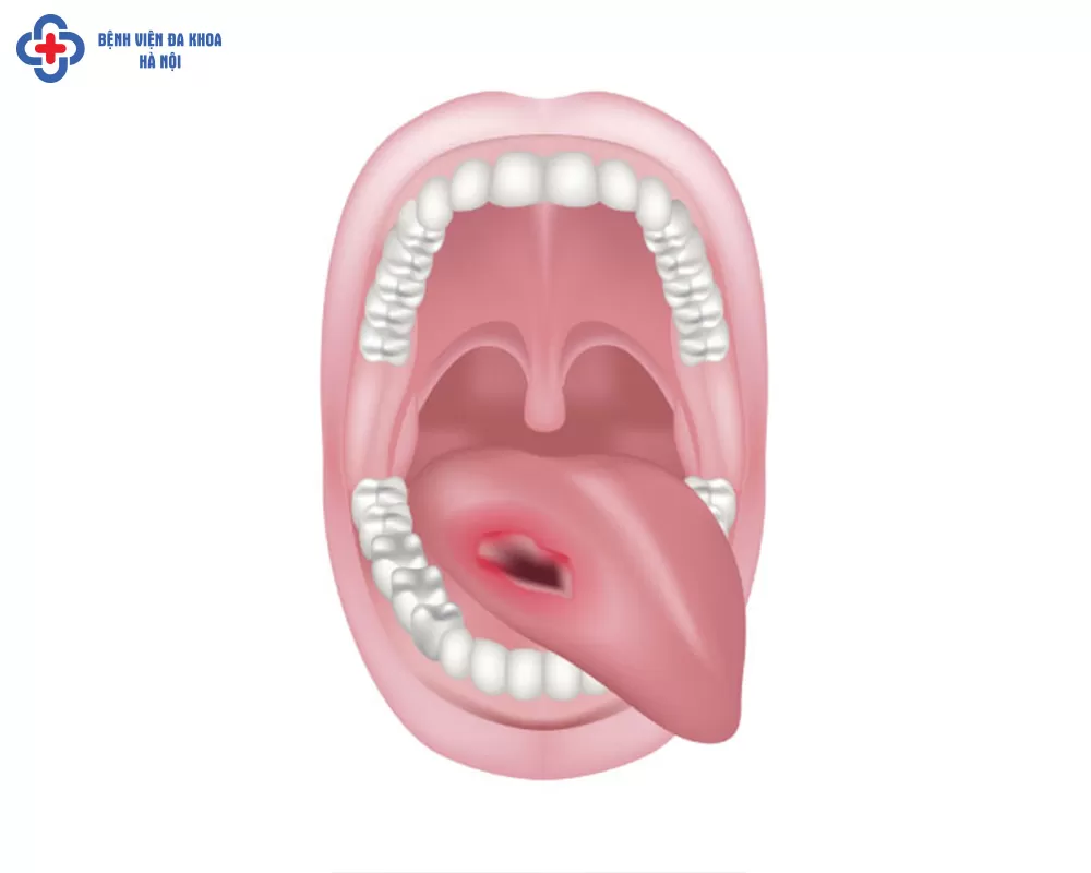 Câu hỏi: Sau cắt ung thư lưỡi, người bệnh có thể nói và ăn uống bình thường trở lại không?