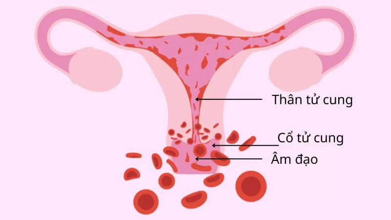 Câu hỏi: Ra máu âm đạo bất thường có phải là dấu hiệu ung thư phụ khoa?