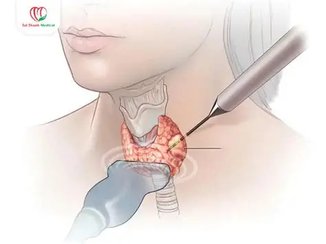 Câu hỏi: Đốt sóng cao tần có đau không?