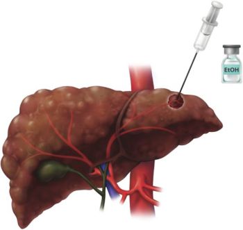 VAI TRÒ CỦA CÁC BIỆN PHÁP TIÊU HỦY TẠI CHỖ KHỐI U GAN TRONG ĐIỀU TRỊ BỆNH UNG THƯ BIỂU MÔ TẾ BÀO GAN