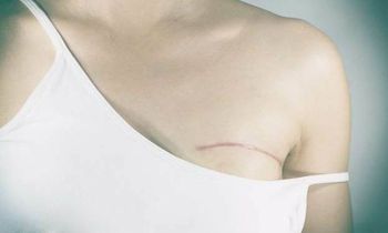 THEO DÕI, CHĂM SÓC SỨC KHỎE SAU ĐIỀU TRỊ UNG THƯ VÚ