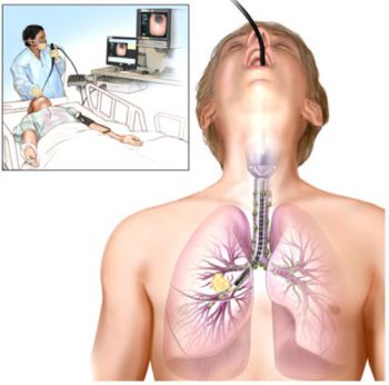 CHẨN ĐOÁN SỚM VÀ ĐIỀU TRỊ UNG THƯ PHỔI QUA NỘI SOI PHẾ QUẢN
