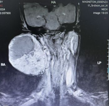 Trì hoãn 14 năm không điều trị, Người phụ nữ suýt mất mạng vì khối U 