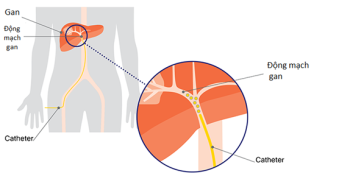 BỆNH NHÂN UNG THƯ GAN CẦN BIẾT