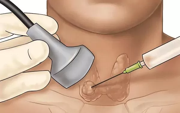 Chọc hút kim nhỏ các khối u dưới hướng dẫn siêu âm