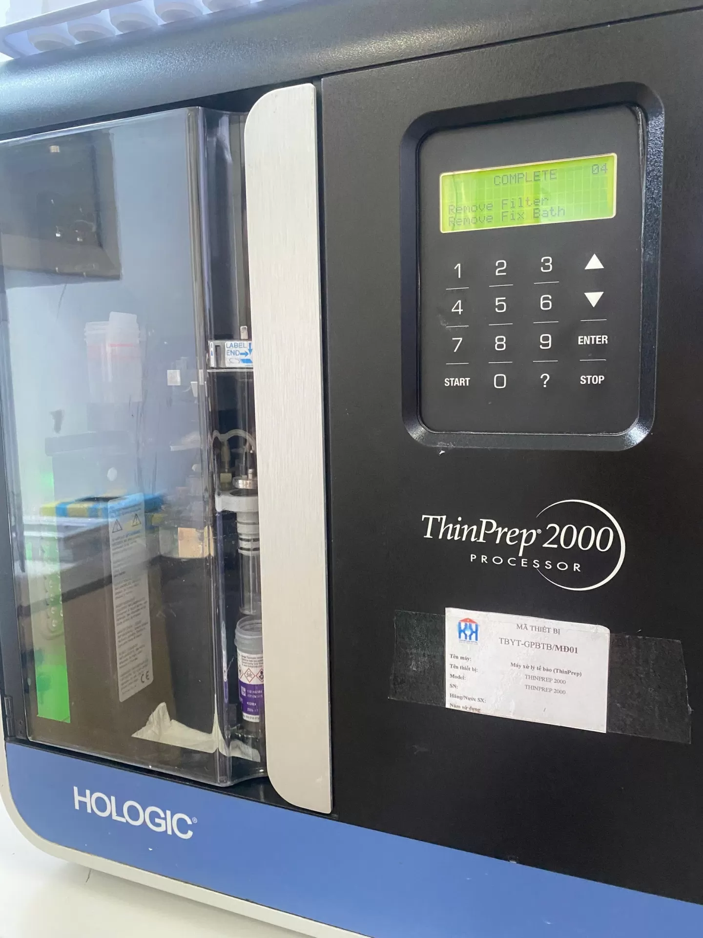 Tầm soát ung thư cổ tử cung hiệu quả hơn với xét nghiệm Liqui-prep tại Bệnh Viện Ung Bướu Hà Nội