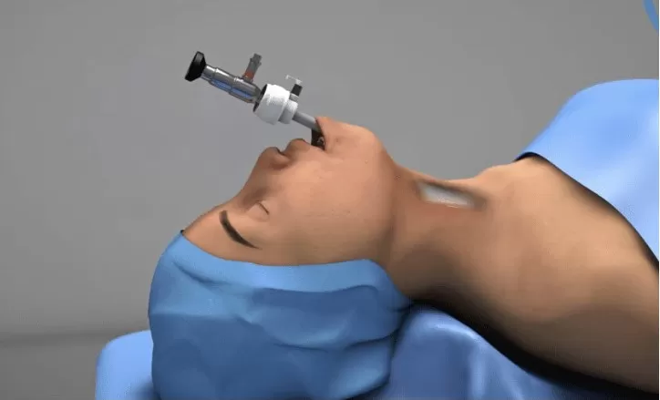 Phẫu thuật nội soi qua đường tiền đình miệng điều trị khối u tuyến giáp