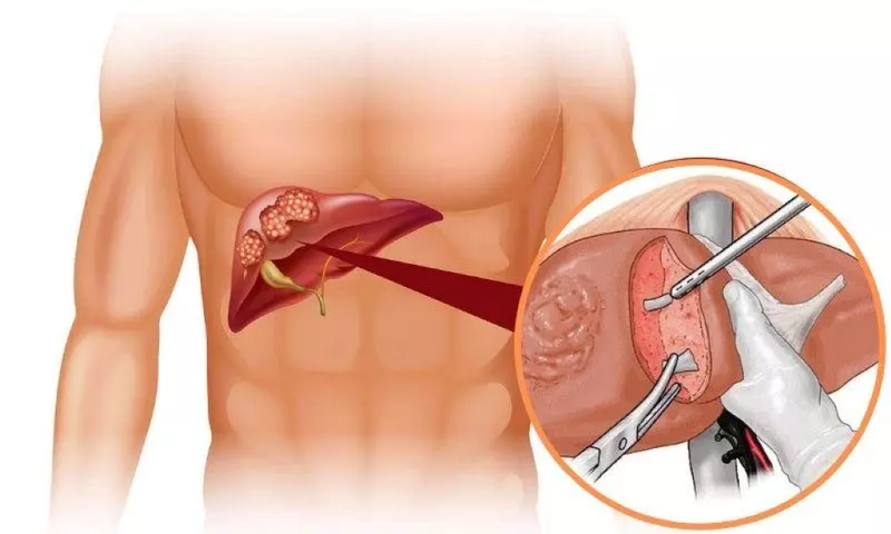 Phẫu thuật cắt gan lớn: 